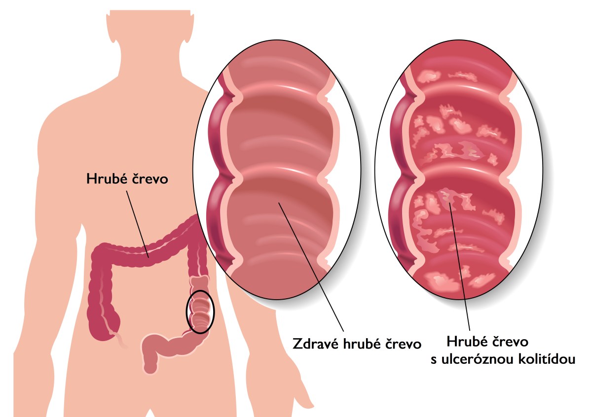 ilustrácia zdravého hrubého čreva a čreva s ulceróznou kolitídou